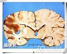 脑梗可以吃角瓜,角瓜助力康复之路